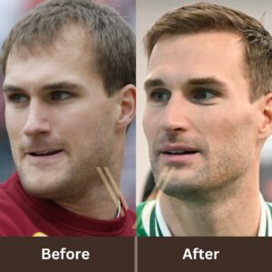 kirk cousins hair tranplant before and after transformation