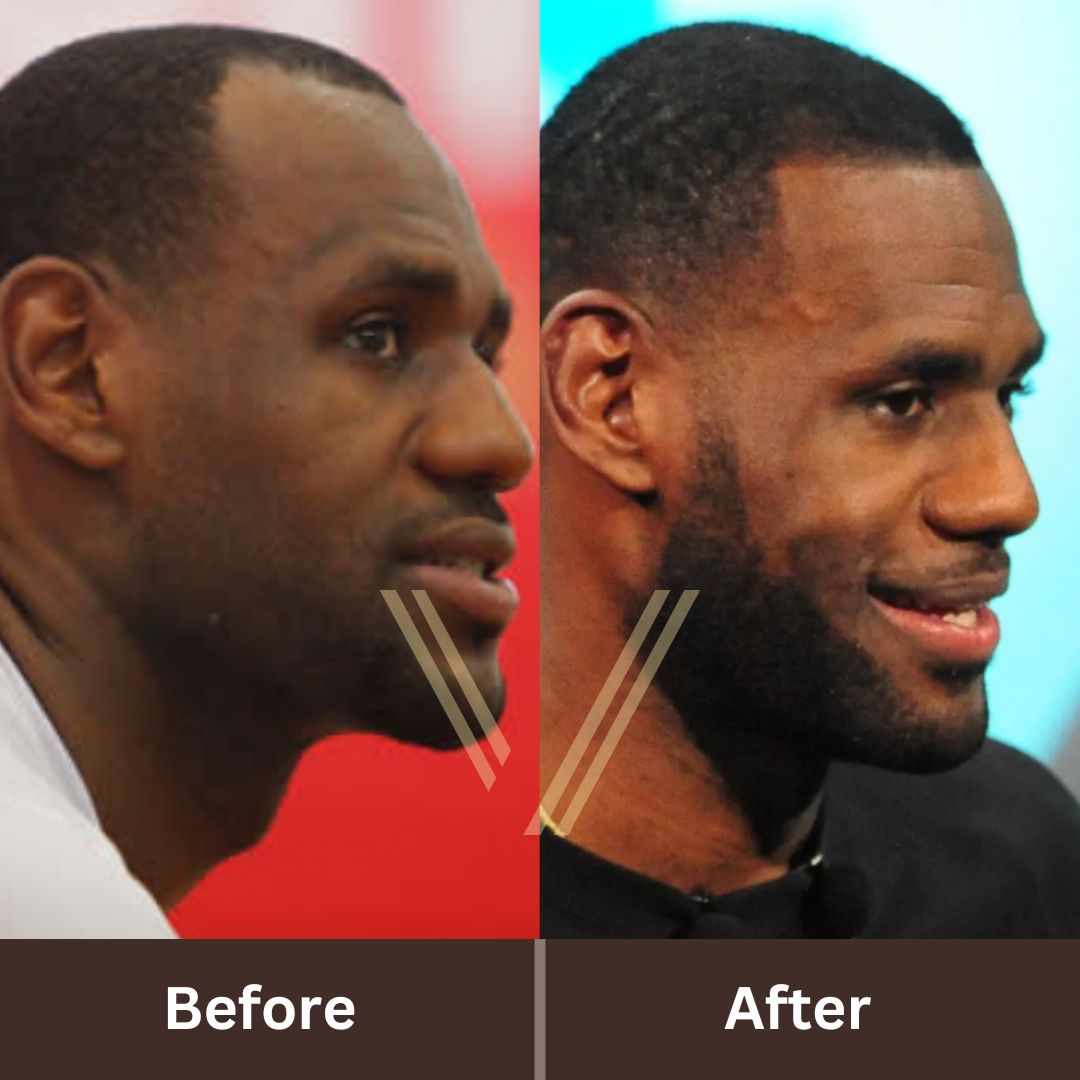 LeBron James Hair Transplant Before and After Transformation