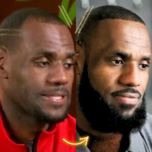 lebron james hair transplant before and after result