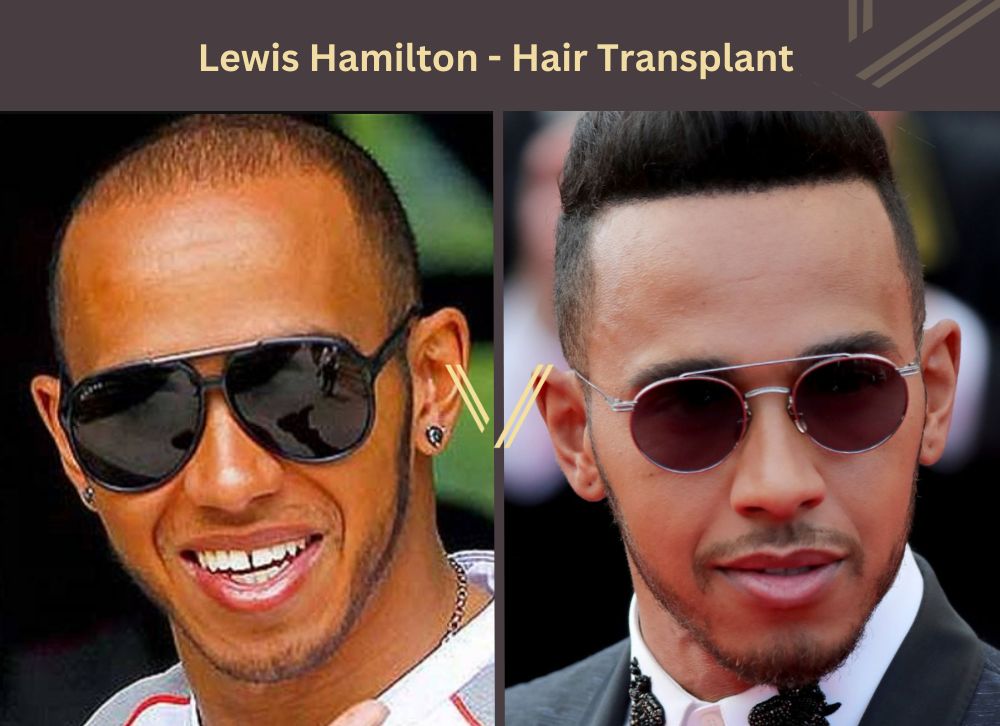 lewis hamilton hair transplant before after