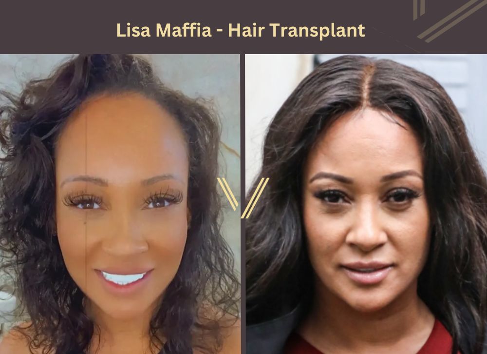Lisa Maffia Hair Transplant