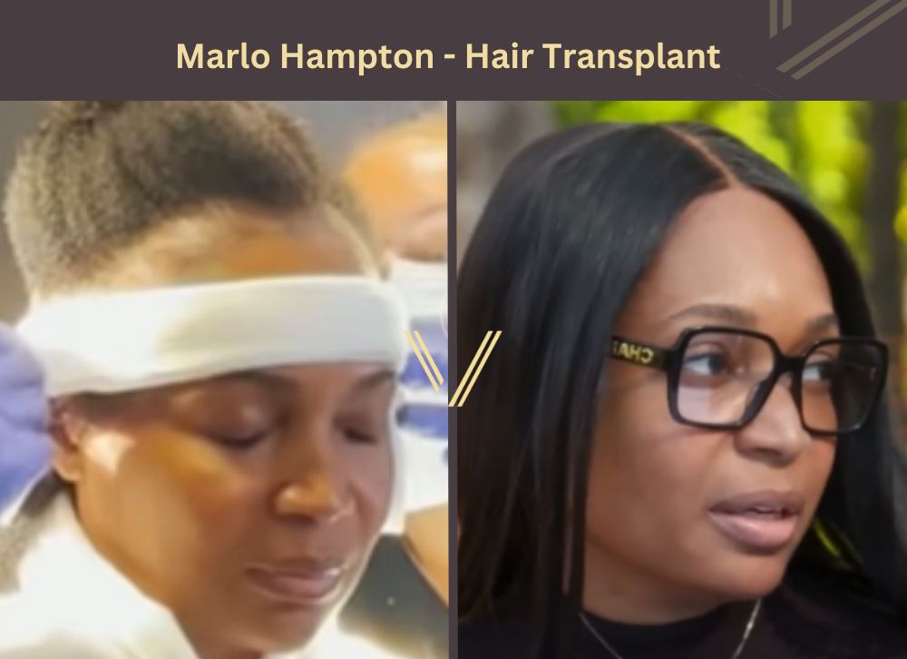 marlo hampton hair transplant before after