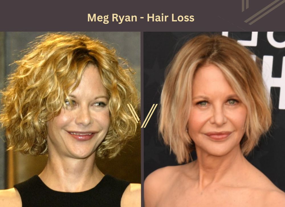 Meg Ryan hair transplant Before and After