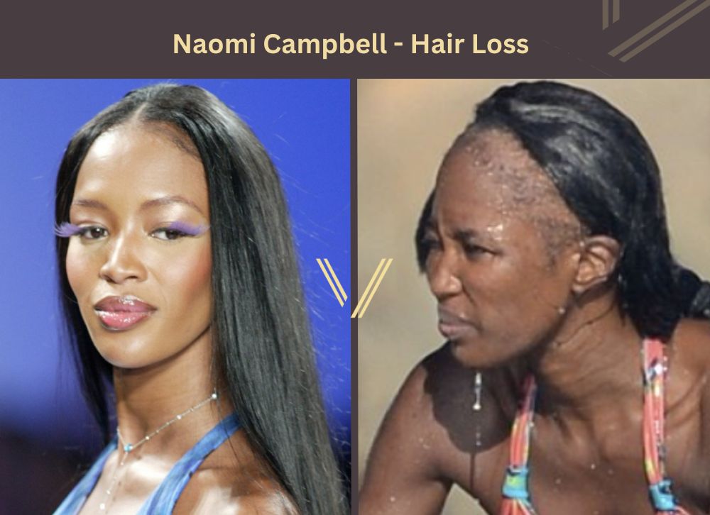 Naomi Campbell Hair Transplant Before and After