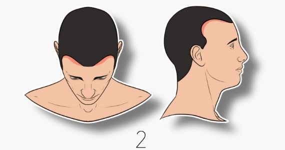 norwood hair loss scale stage 2 2000 grafts 