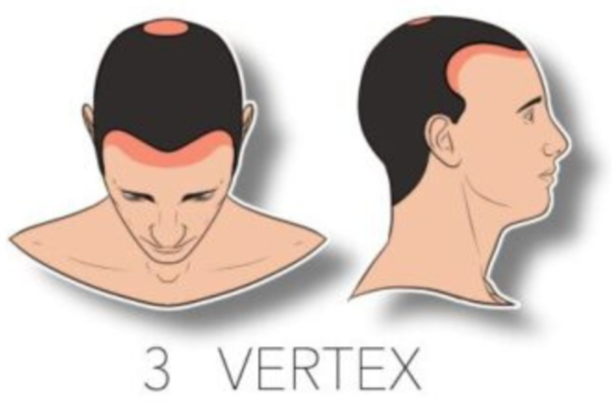 norwood hair loss scale stage 3 vertex 3500 grafts 