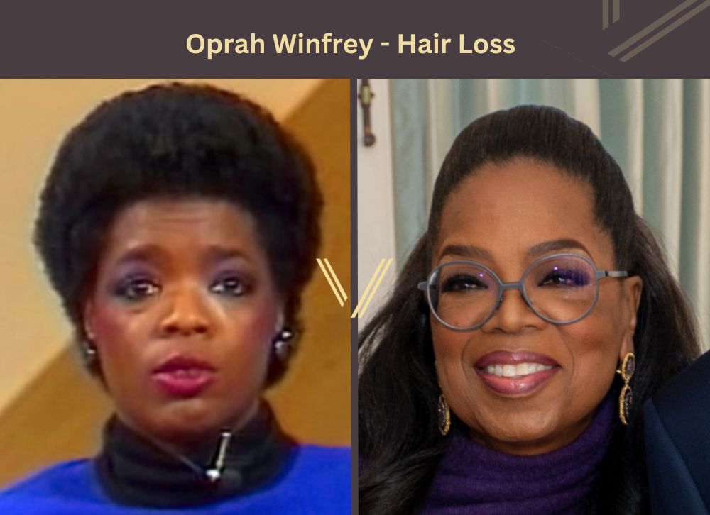 Oprah Winfrey Hair Transplant Before and After