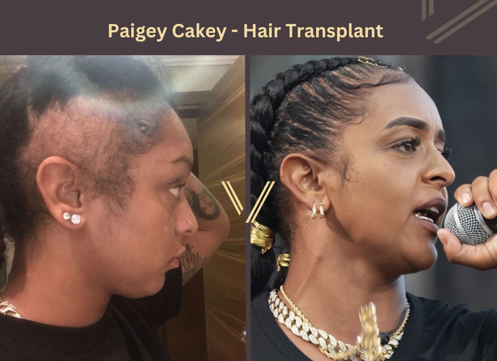 Paigey Cakey Hair Transplant Before and After