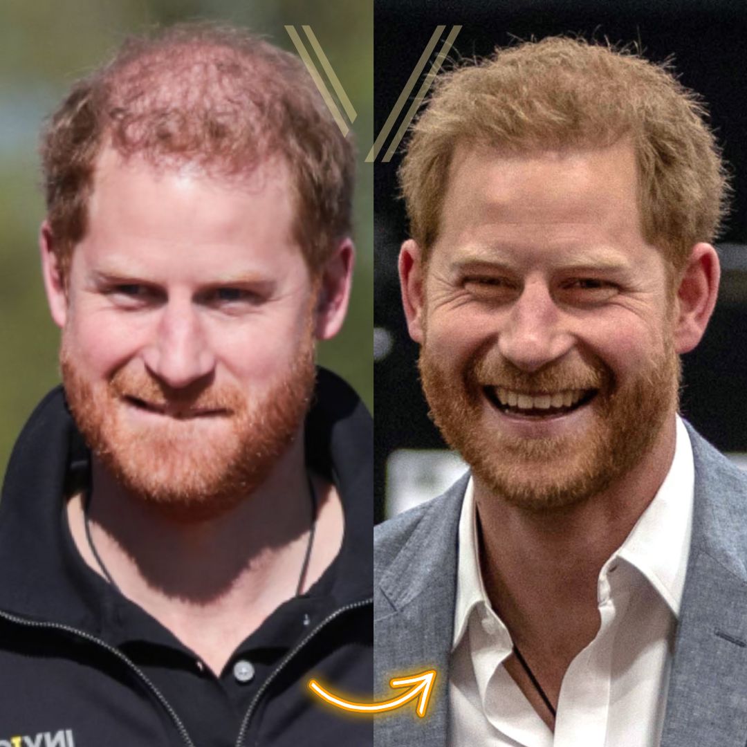 Prince Harry's Hair Transplant: Before and After Transformation