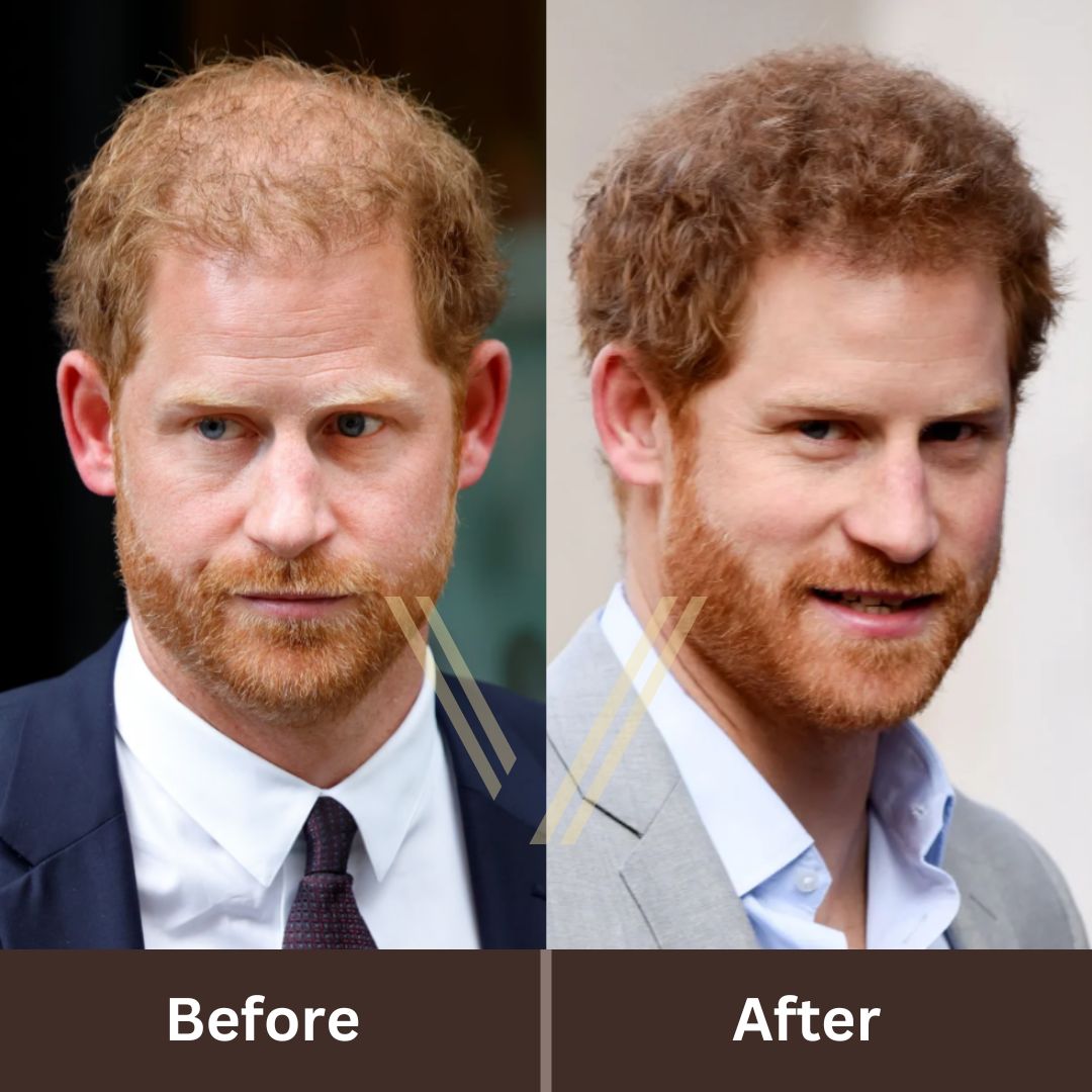 Prince Harry's Hair Transplant: Before and After Transformation