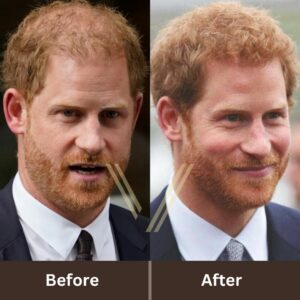 prince harry hair transplant before and after
