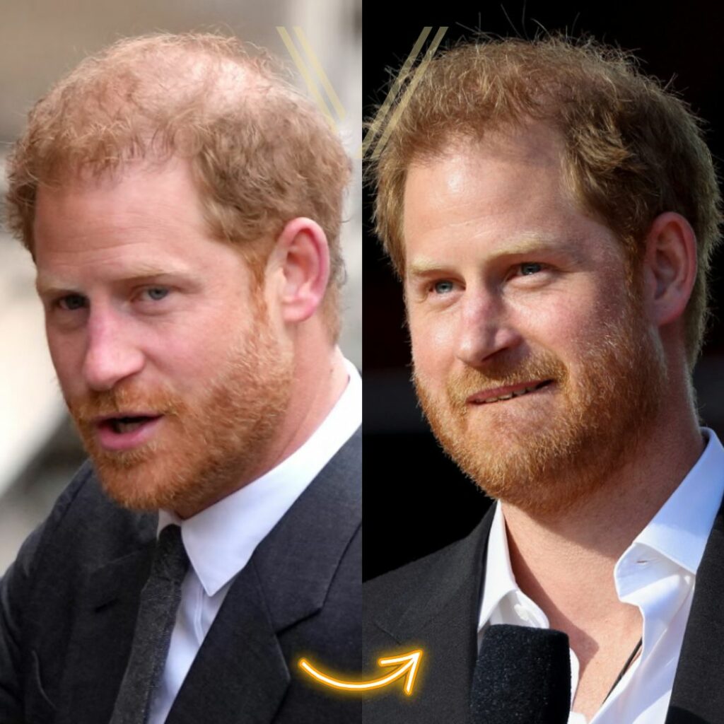 Prince Harry's Hair Transplant: Before and After Transformation