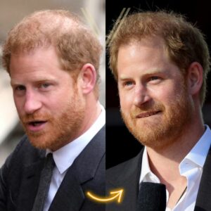 prince harry hair transplant before and after result