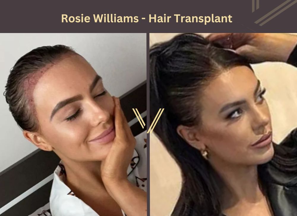 Rosie Williams hair transplant Before and After