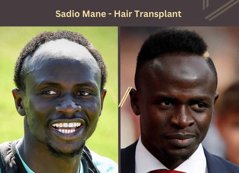 sadio mane hair transplant before after