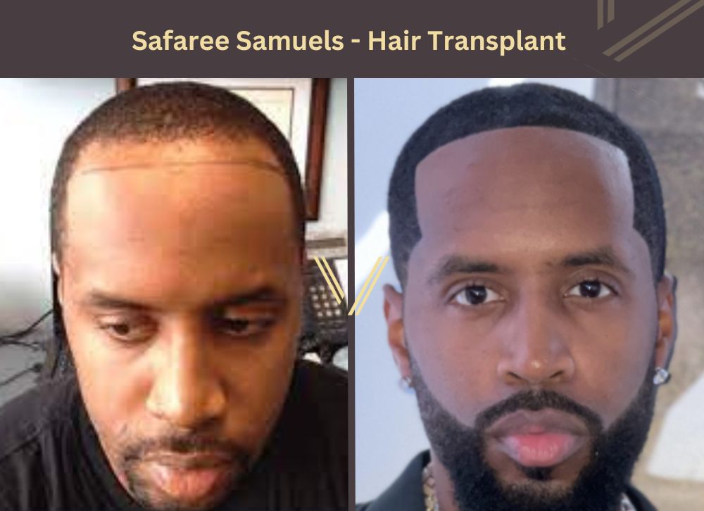 safaree samuels hair transplant before after