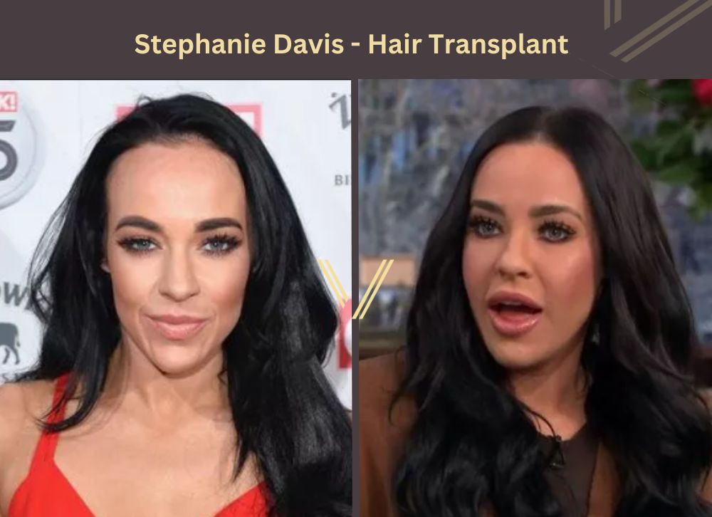 Stephanie Davis hair transplant before and After