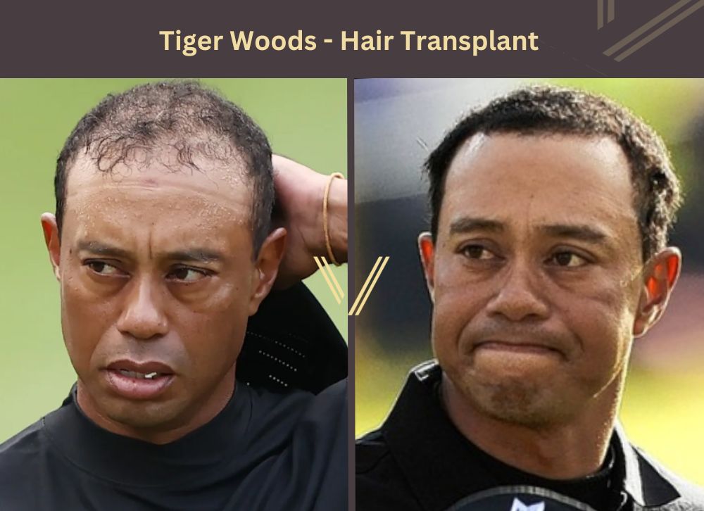tiger woods hair transplant before after