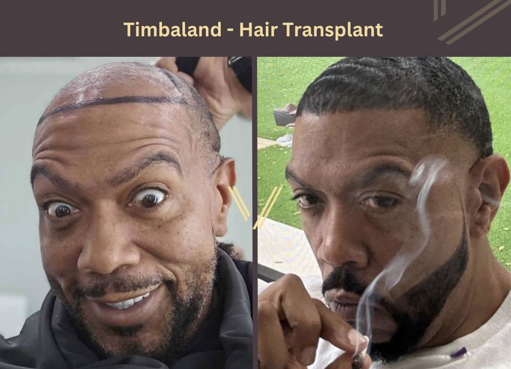 timbaland hair transplant before after