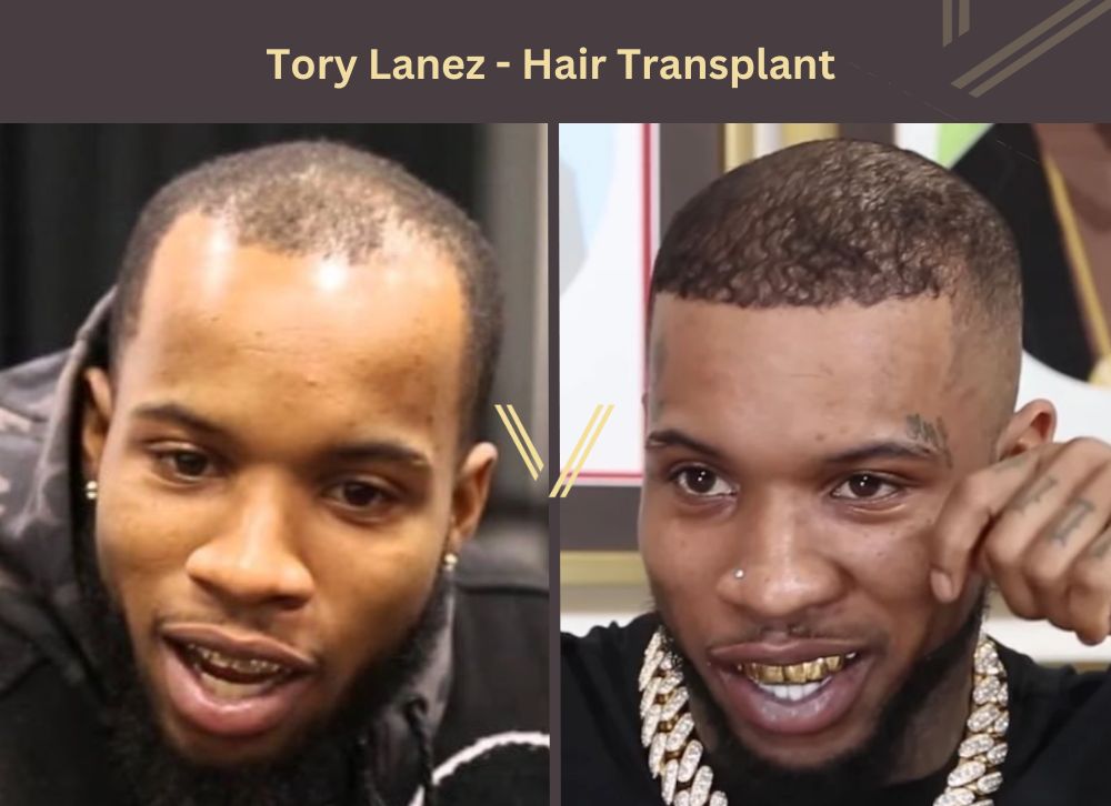 tory lanez hair transplant before after