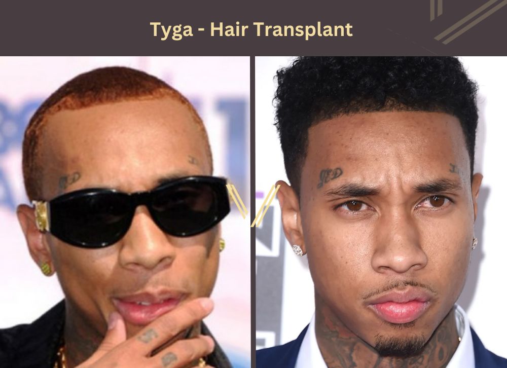 tyga hair transplant before after