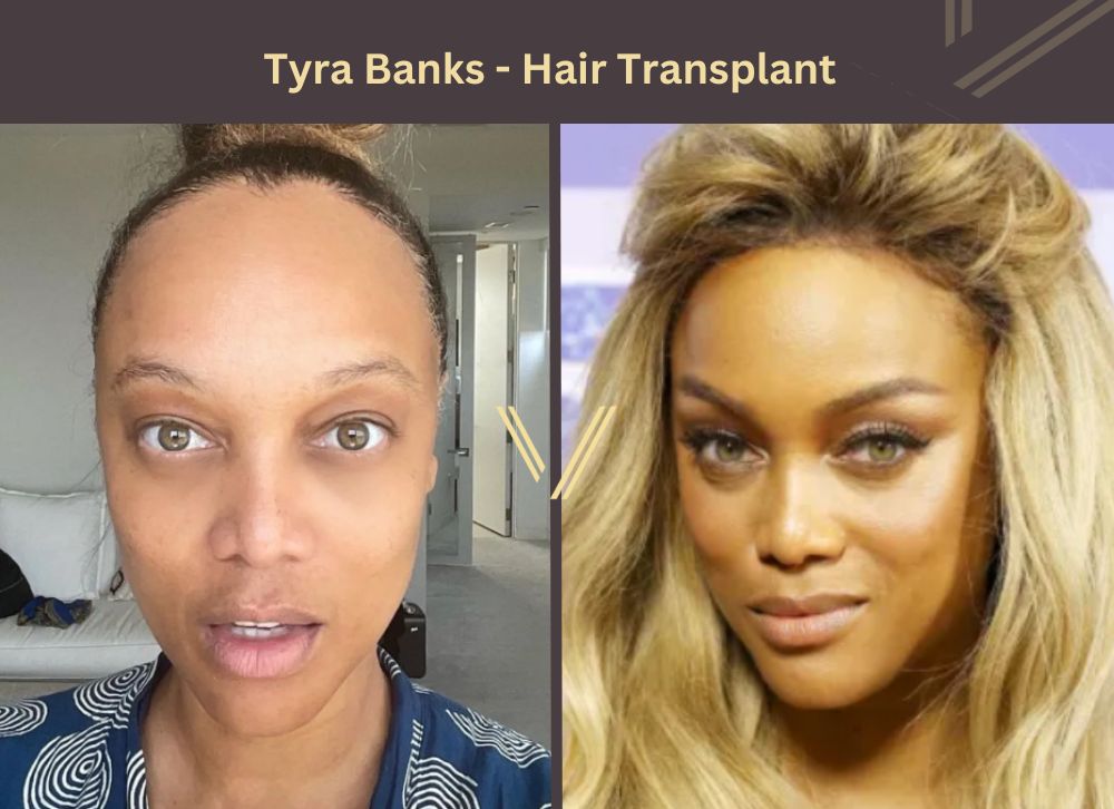 Tyra Banks hair transplant Before and After Photos