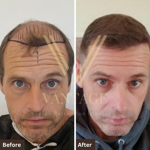 8000 grafts before after hair transformation