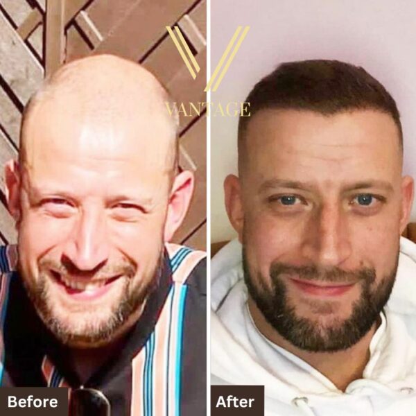8000 grafts hair transplant before after