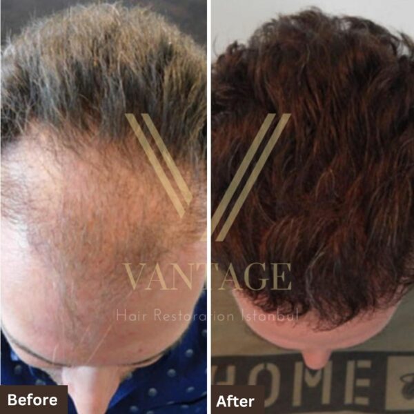 8000 grafts hair transplant before and after