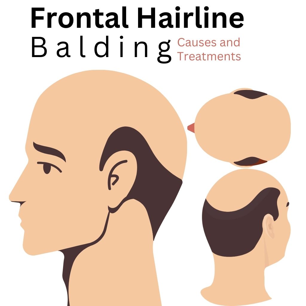 Frontal hairline Balding Causes