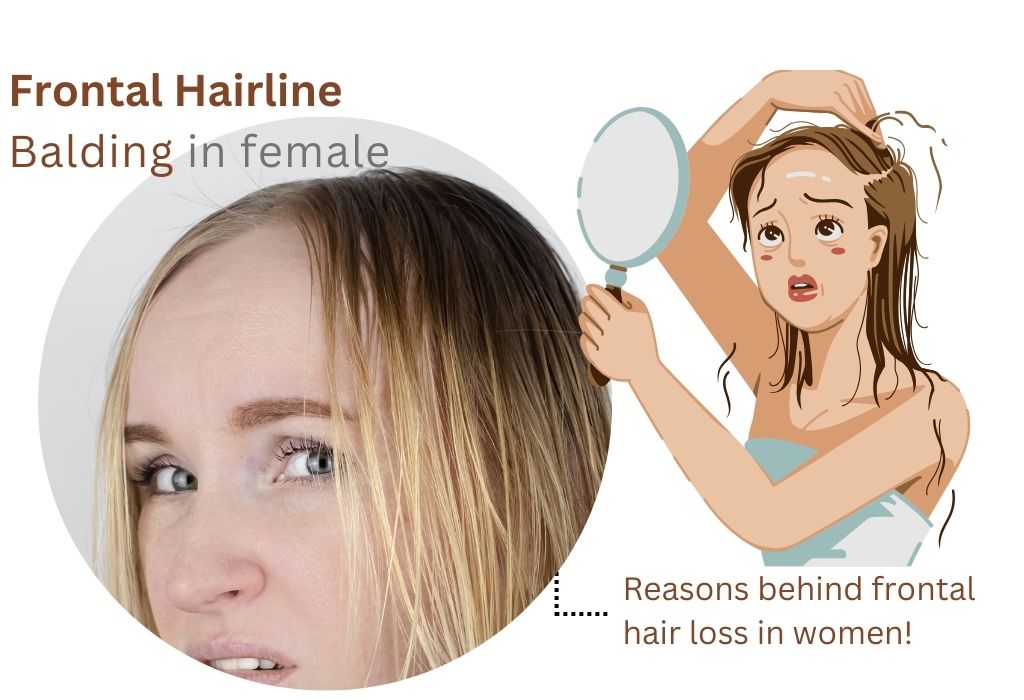 Frontal hairline Balding in female