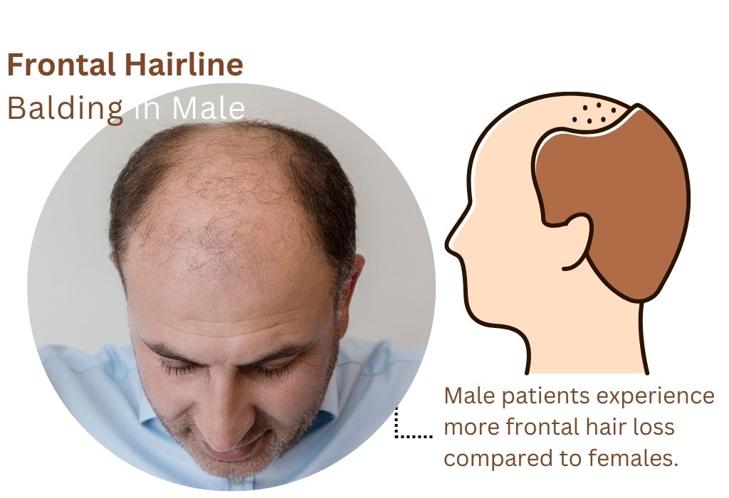 Frontal hairline Balding in male