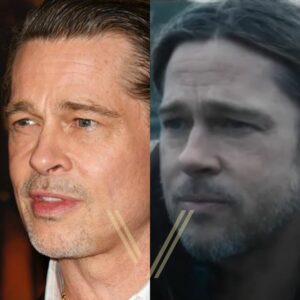 before and after result of brad pitt hair transplant
