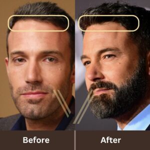 ben affleck hair transplant before after 