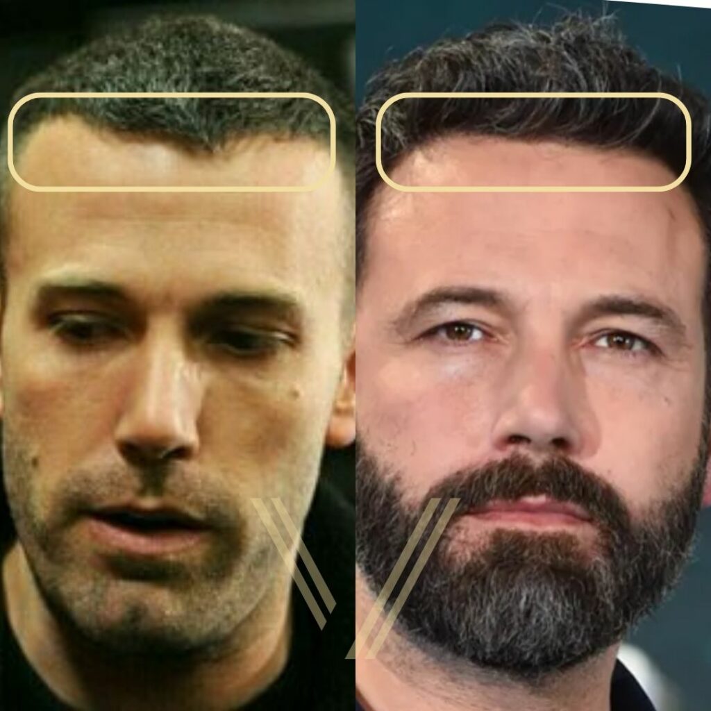 Ben Affleckβs Hair Transplant: Before and After Transformation