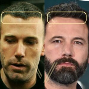 ben affleck hair transplant before and after 
