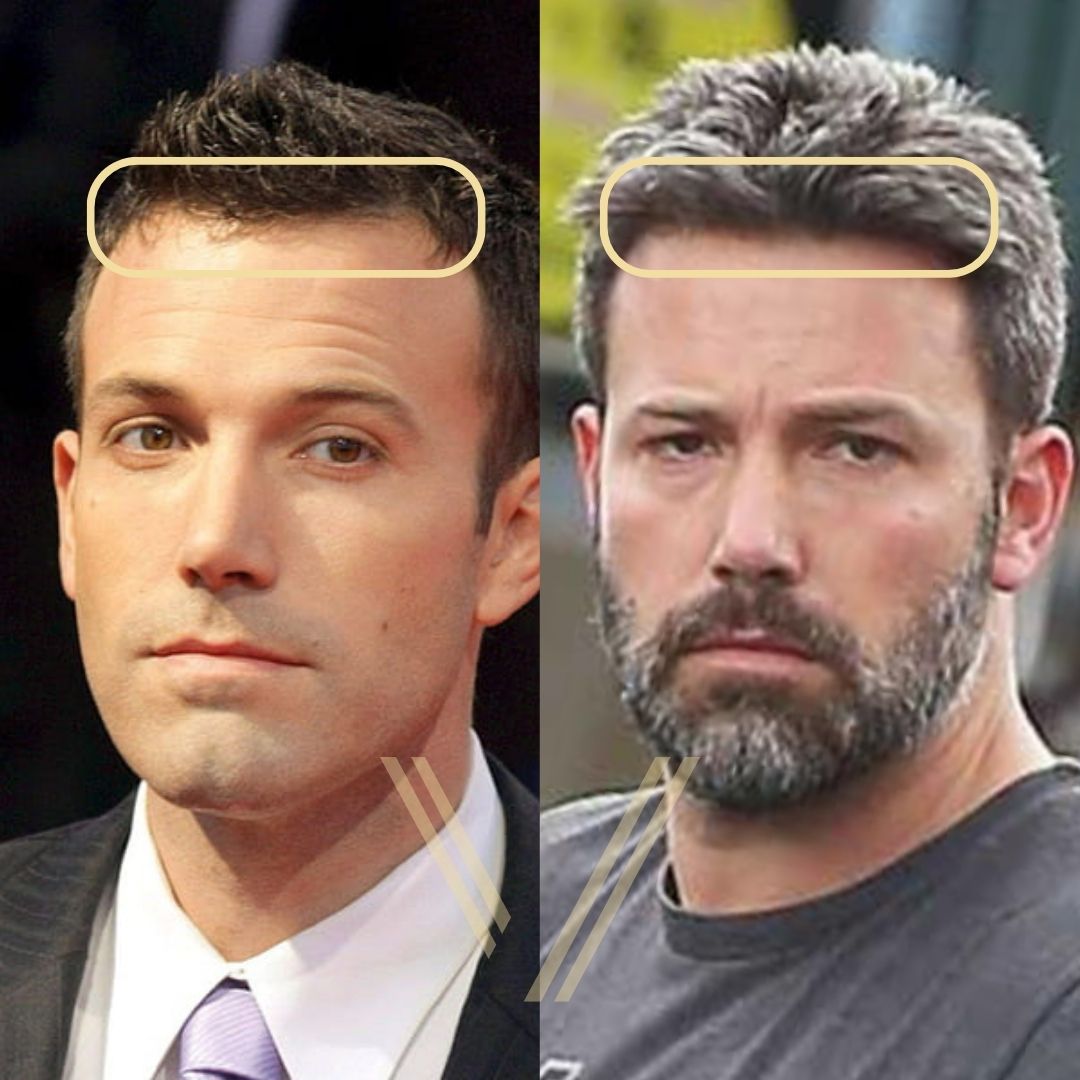 Ben Affleck’s Hair Transplant: Before and After Transformation