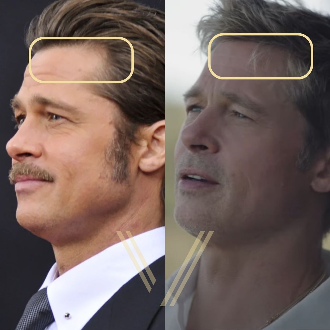 Brad Pitt’s Hair Transplant Before and After Transformation