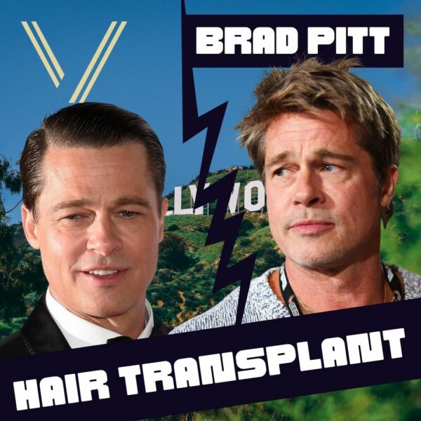 brad pitt hair transplant