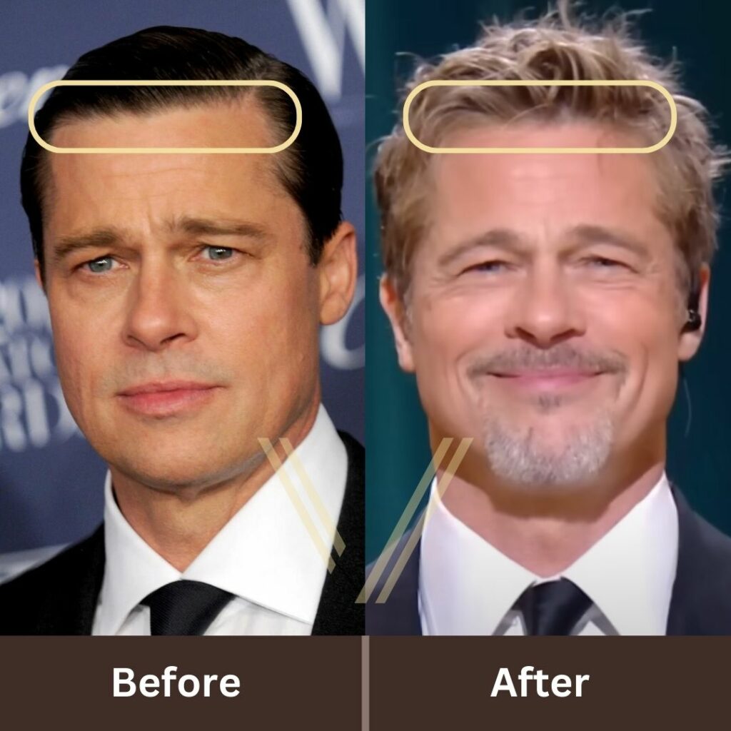 Brad Pitt’s Hair Transplant: Before and After Transformation