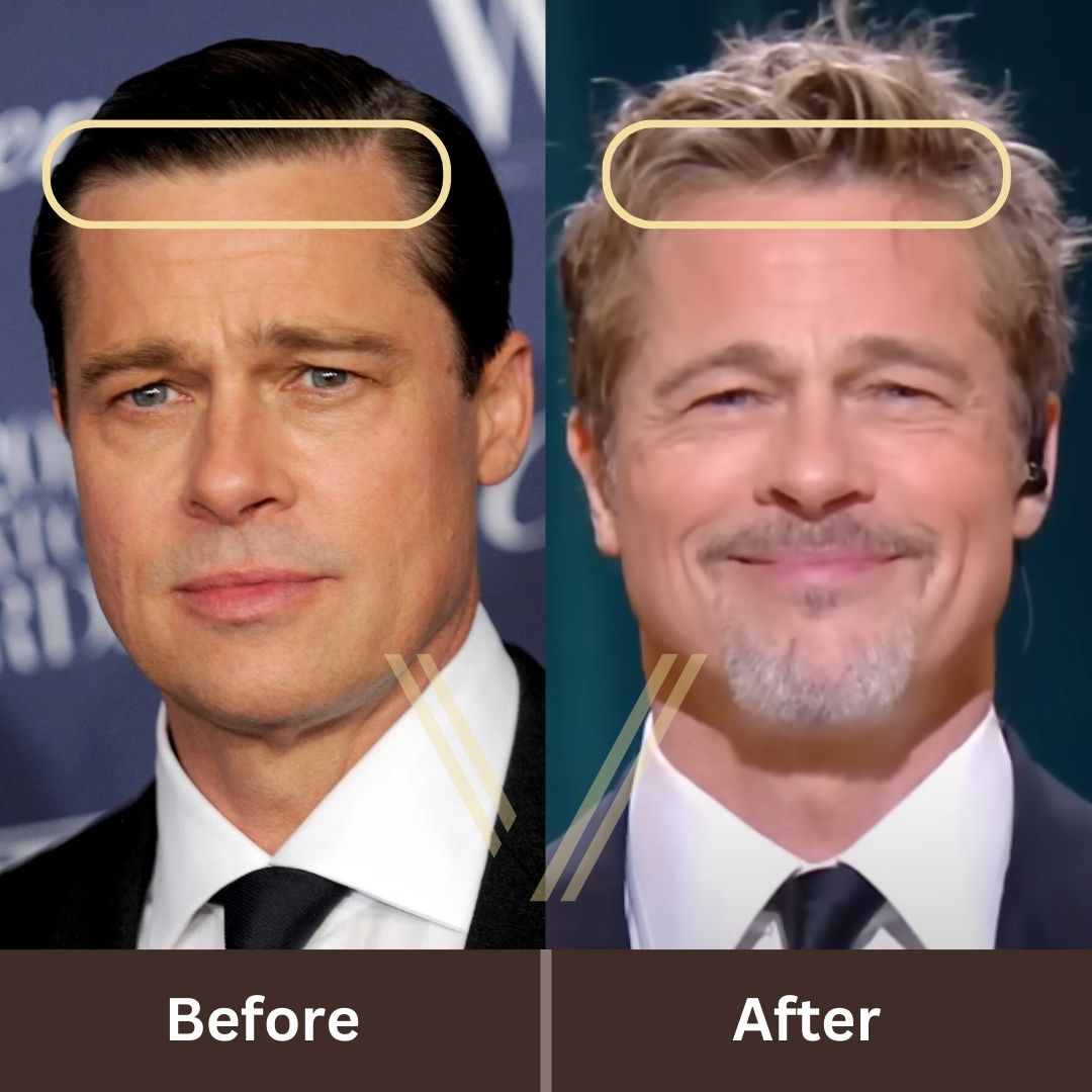 Brad Pitt’s Hair Transplant: Before and After Transformation