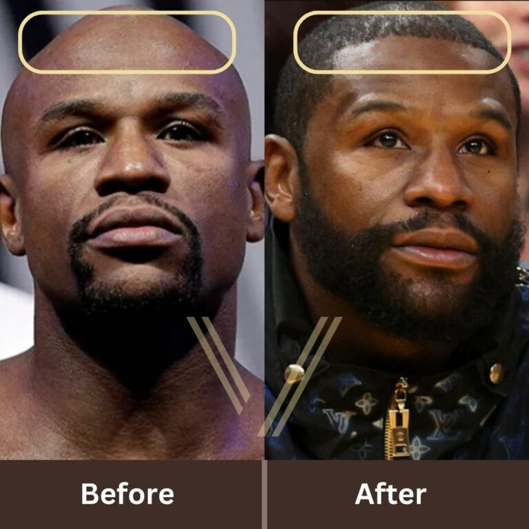 Floyd Mayweather Hair Transplant Before and After Result