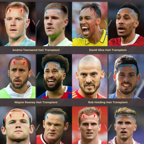 footballers with hair transplant
