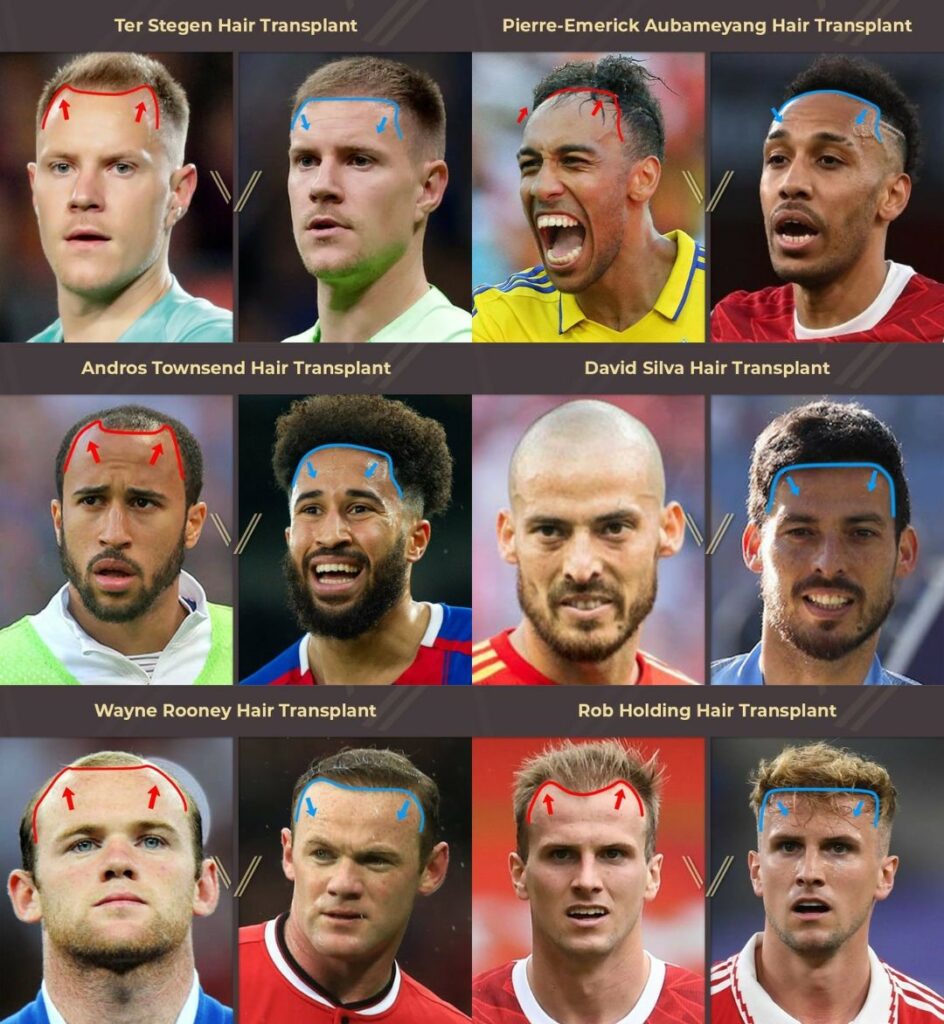 footballers with hair transplant