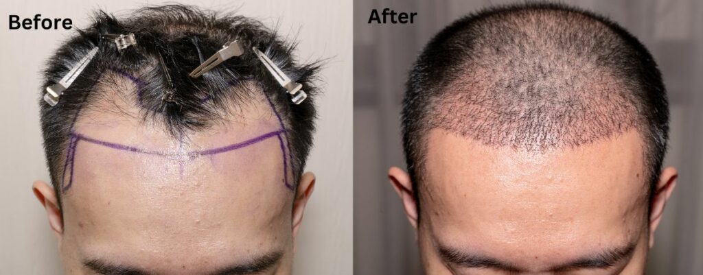 Results after hair transplant
