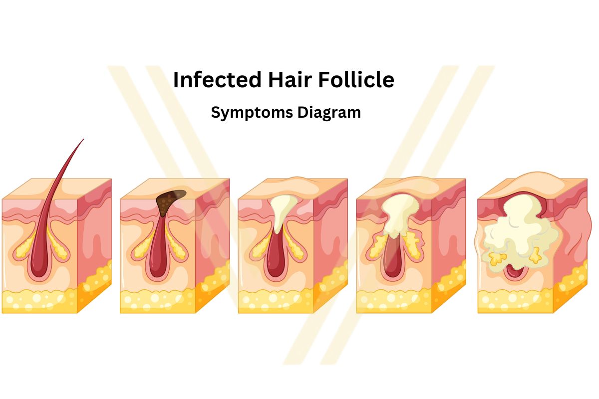 infected hair follicle Symptoms