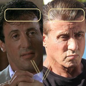 sylvester stallone hair transplant before after result