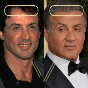 sylvester stallone hair transplant before and after result