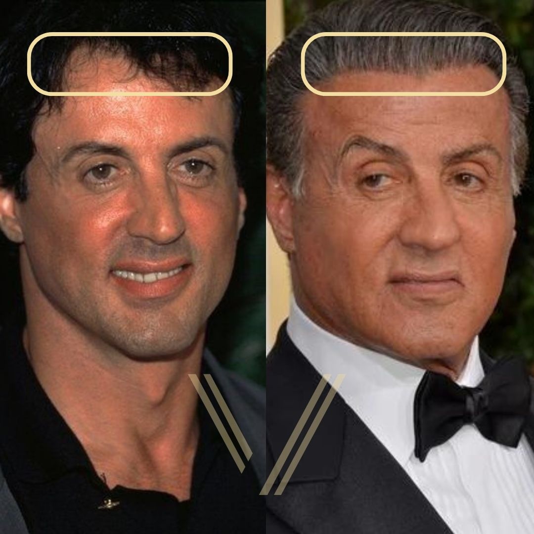 Sylvester Stallone Hair Transplant: Before and After Result