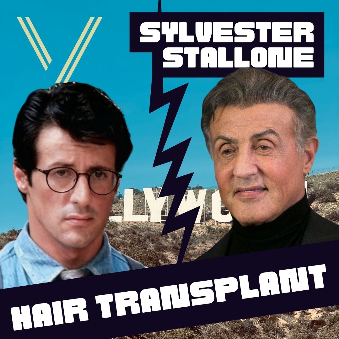 sylvester stallone hair transplant